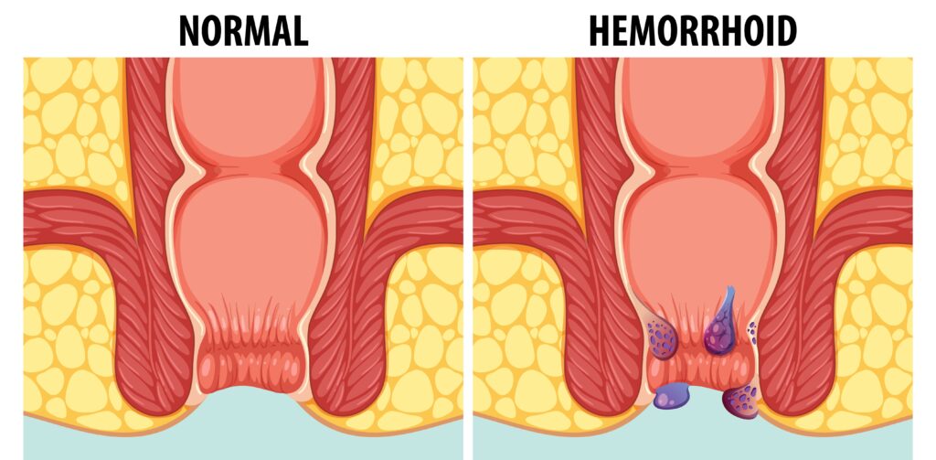 पाइल्स रोग क्या है? खूनी बवासीर का घरेलू उपचार, दवाइयाँ और बचाव के तरीके